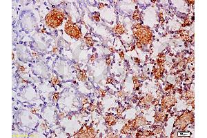 Formalin-fixed and paraffin embedded human gastric carcinoma labeled Anti-MAdCAM-1 Polyclonal Antibody, Unconjugated at 1:200, followed by conjugation to the secondary antibody and DAB staining (MADCAM1 抗体  (AA 151-250))