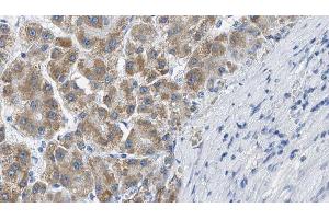 ABIN6269382 at 1/100 staining Human liver cancer tissue by IHC-P. (B-Cell Linker 抗体  (N-Term))
