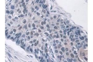 Detection of AHNAK in Human Lung cancer Tissue using Polyclonal Antibody to Desmoyokin (AHNAK)