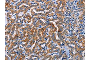 The image on the left is immunohistochemistry of paraffin-embedded Human thyroid cancer tissue using ABIN7128355(ALG12 Antibody) at dilution 1/20, on the right is treated with fusion protein. (ALG12 抗体)