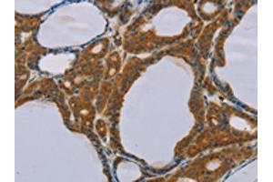 The image on the left is immunohistochemistry of paraffin-embedded Human thyroid cancer tissue using ABIN7130584(PEF1 Antibody) at dilution 1/20, on the right is treated with fusion protein. (PEF1 抗体)