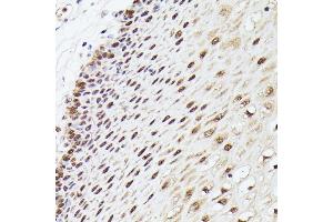 Immunohistochemistry of paraffin-embedded human esophageal using MLF2 antibody (ABIN7268725) at dilution of 1:100 (40x lens). (MLF2 抗体  (AA 1-65))