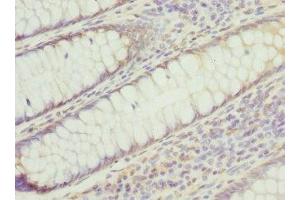 Immunohistochemistry of paraffin-embedded human colon cancer using ABIN7142221 at dilution of 1:100 (PSMD8 抗体  (Regulatory Subunit 8))