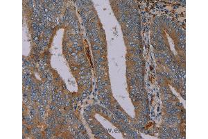 Immunohistochemistry of Human thyroid cancer using PYY Polyclonal Antibody at dilution of 1:40