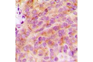 Immunohistochemical analysis of 14-3-3 zeta staining in human breast cancer formalin fixed paraffin embedded tissue section. (14-3-3 zeta 抗体  (C-Term))