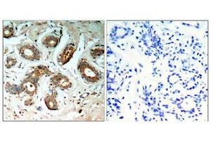 Immunohistochemical analysis of paraffin-embedded human breast carcinoma tissue using 14-3-3z(Phospho-Ser58) Antibody(left) or the same antibody preincubated with blocking peptide(right). (14-3-3 zeta 抗体  (pSer58))