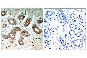 Immunohistochemical analysis of paraffin-embedded human breast carcinoma tissue using 14-3-3z(Phospho-Ser58) Antibody(left) or the same antibody preincubated with blocking peptide(right).