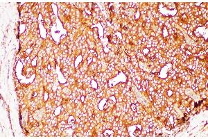 Immunohistochemistry of paraffin-embedded Human prostate cancer using FOLH1 Polycloanl Antibody at dilution of 1:200 (PSMA 抗体)