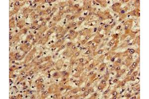 Immunohistochemistry of paraffin-embedded human liver cancer using ABIN7150673 at dilution of 1:100 (TGDS 抗体  (AA 143-305))