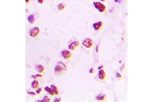Immunohistochemical analysis of p300 staining in human lung cancer formalin fixed paraffin embedded tissue section. (p300 抗体  (N-Term))