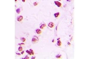 Immunohistochemical analysis of p300 staining in human lung cancer formalin fixed paraffin embedded tissue section.