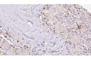 ABIN6273309 at 1/100 staining Human thyroid cancer tissue by IHC-P. (RIC8B 抗体  (C-Term))