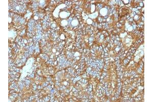ABIN6383801 to EpCAM was successfully used to stain cellular membranes in human colorectal and hepatocellular carcinoma sections.