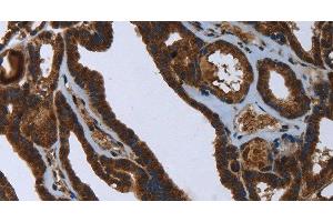 Immunohistochemistry of paraffin-embedded Human thyroid cancer using FASTKD2 Polyclonal Antibody at dilution of 1:45 (FASTKD2 抗体)