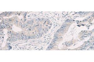 Immunohistochemistry of paraffin-embedded Human colorectal cancer tissue using WNK4 Polyclonal Antibody at dilution of 1:45(x200) (WNK4 抗体)