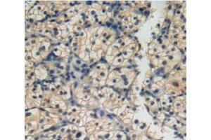 IHC-P analysis of kidney cancer tissue, with DAB staining. (IL12RB2 抗体  (AA 145-275))
