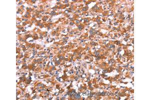 Immunohistochemistry of Human gastric cancer using GAS8 Polyclonal Antibody at dilution of 1:30 (GAS8 抗体)