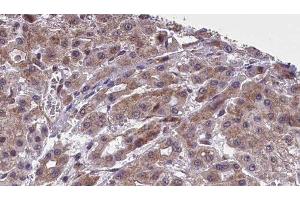 ABIN6277402 at 1/100 staining Human liver cancer tissue by IHC-P. (SLC16A4 抗体  (Internal Region))