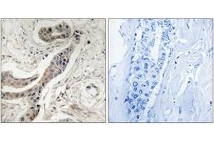 Immunohistochemistry analysis of paraffin-embedded human breast carcinoma, using BCL-XL (Phospho-Thr115) Antibody. (BCL2L1 抗体  (pThr115))