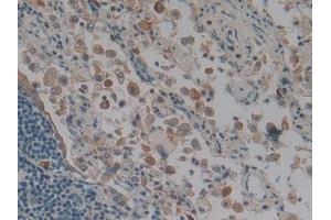 IHC-P analysis of Human Lung cancer Tissue, with DAB staining. (Keratin 3 抗体  (AA 198-514))