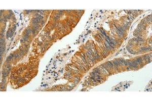 Immunohistochemistry of paraffin-embedded Human colon cancer using SH-PTP1 Polyclonal Antibody at dilution of 1:35 (SHP1 抗体)