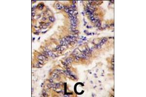 Formalin-fixed and paraffin-embedded human lung carcinoma tissue reacted with TRAPPC4 antibody , which was peroxidase-conjugated to the secondary antibody, followed by DAB staining. (TRAPPC4 抗体  (N-Term))