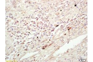 Formalin-fixed and paraffin embedded human lung carcinoma labeled with Rabbit Anti KIF11/Eg5/TRIP5 Polyclonal Antibody, Unconjugated (ABIN872373) at 1:200 followed by conjugation to the secondary antibody and DAB staining