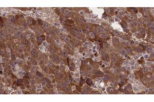 ABIN6277378 at 1/100 staining Human liver cancer tissue by IHC-P. (GRM8 抗体  (C-Term))