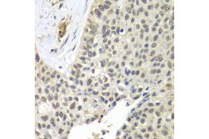 Immunohistochemistry of paraffin-embedded human lung cancer using SNRPD2 antibody at dilution of 1:100 (x40 lens). (SNRPD2 抗体)