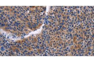 Immunohistochemistry of paraffin-embedded Human liver cancer tissue using IGSF10 Polyclonal Antibody at dilution 1:50 (IGSF10 抗体)
