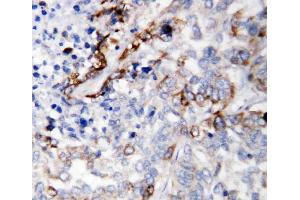 Anti-LAMC2 antibody, IHC(P): Human Lung Cancer Tissue (LAMC2 抗体  (C-Term))