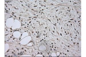 Immunohistochemical staining of paraffin-embedded Carcinoma of kidney tissue using anti-SATB1mouse monoclonal antibody. (SATB1 抗体)