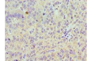 Immunohistochemistry of paraffin-embedded human liver cancer using ABIN7158607 at dilution of 1:100 (LYVE1 抗体  (AA 20-238))