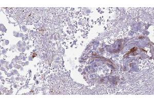 ABIN6273454 at 1/100 staining Human urothelial cancer tissue by IHC-P. (CD97 抗体  (Internal Region))