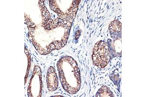 Immunohistochemistry of paraffin-embedded human prostate cancer using Arginase 2 (Arginase 2 ) Rabbit mAb (ABIN7265661) at dilution of 1:100 (40x lens). (ARG2 抗体  (Arg2))