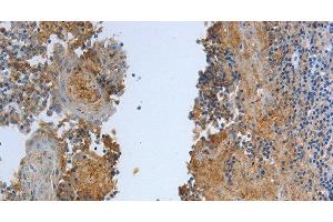 Immunohistochemistry of paraffin-embedded Human tonsil tissue using DLG4 Polyclonal Antibody at dilution 1:30 (DLG4 抗体)