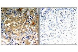 Immunohistochemical analysis of paraffin-embedded human lung carcinoma tissue using PKCζ (Phospho-Thr410) antibody. (PKC zeta 抗体  (pThr410))