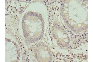 Immunohistochemistry of paraffin-embedded human colon cancer using ABIN7154629 at dilution of 1:100 (K-RAS 抗体  (AA 2-168))