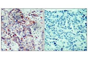 Immunohistochemical analysis of paraffin-embedded human breast carcinoma tissue using SEK1/MKK4(Phospho-Ser80) Antibody(left) or the same antibody preincubated with blocking peptide(right). (MAP2K4 抗体  (pSer80))