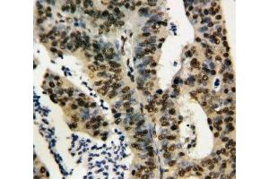 IHC-P: TNFAIP1 antibody testing of human rectal cancer tissue