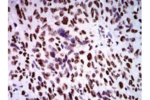 Immunohistochemical analysis of paraffin-embedded ovarian cancer tissues using ZFP91 mouse mAb with DAB staining. (ZFP91 抗体  (AA 162-304))