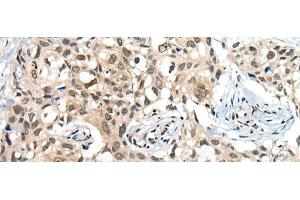 Immunohistochemistry of paraffin-embedded Human lung cancer tissue using CDKL2 Polyclonal Antibody at dilution of 1:25(x200) (CDKL2 抗体)