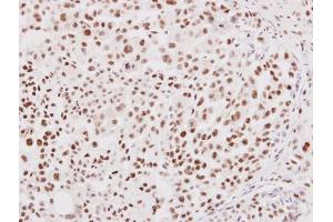 IHC-P Image NRF1 antibody detects NRF1 protein at nucleus on human lung adenocarcinoma by immunohistochemical analysis.
