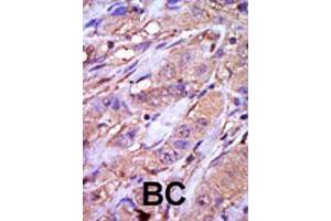 Formalin-fixed and paraffin-embedded human cancer tissue reacted with CSNK1E polyclonal antibody  , which was peroxidase-conjugated to the secondary antibody, followed by DAB staining. (CK1 epsilon 抗体  (C-Term))