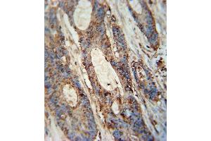 FA antibody (Center) (ABIN654352 and ABIN2844119) immunohistochemistry analysis in formalin fixed and paraffin embedded human colon carcinoma followed by peroxidase conjugation of the secondary antibody and DAB staining. (FAM46A 抗体  (AA 89-117))