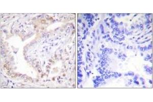 Immunohistochemistry analysis of paraffin-embedded human lung carcinoma tissue, using Lamin A (Cleaved-Asp230) Antibody. (Lamin A/C 抗体  (Cleaved-Asp230))