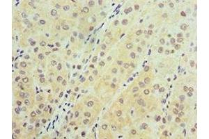 Immunohistochemistry of paraffin-embedded human liver cancer using ABIN7143632 at dilution of 1:100 (AARS2 抗体  (AA 841-985))