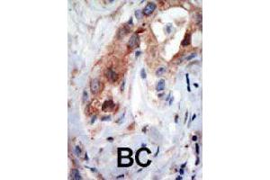 Formalin-fixed and paraffin-embedded human cancer tissue reacted with PIP5K1B polyclonal antibody  , which was peroxidase-conjugated to the secondary antibody, followed by AEC staining. (PIP5K1B 抗体  (N-Term))