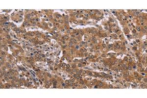 Immunohistochemistry of paraffin-embedded Human liver cancer tissue using FAAH2 Polyclonal Antibody at dilution 1:30 (FAAH2 抗体)