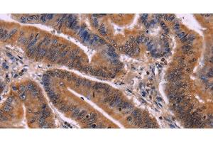 Immunohistochemistry of paraffin-embedded Human colon cancer tissue using CDC5L Polyclonal Antibody at dilution 1:40 (CDC5L 抗体)